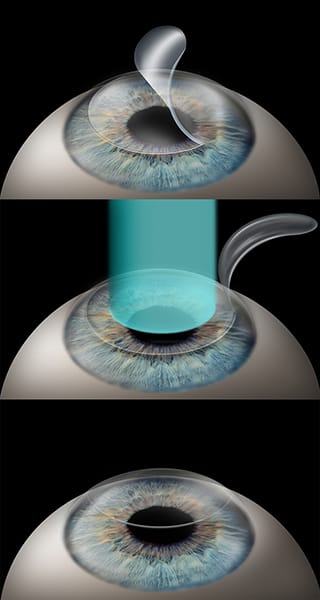 LASIK Eye Surgery